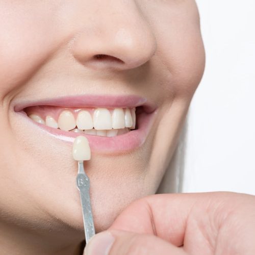 Close Up of mouth of happy woman and a shade guide