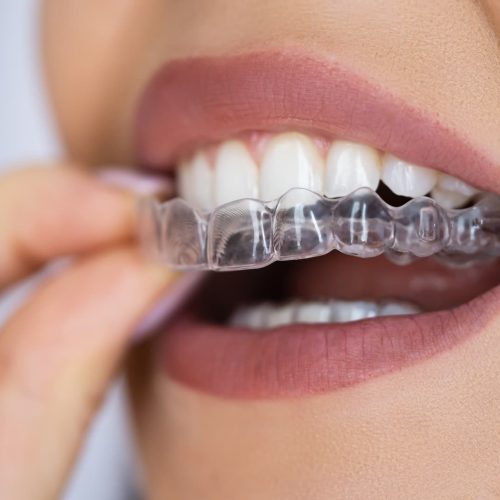 Clear Aligner Dental Night Guard For Teeth